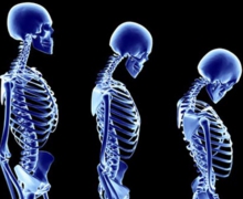 osteoporosis-posture.jpg